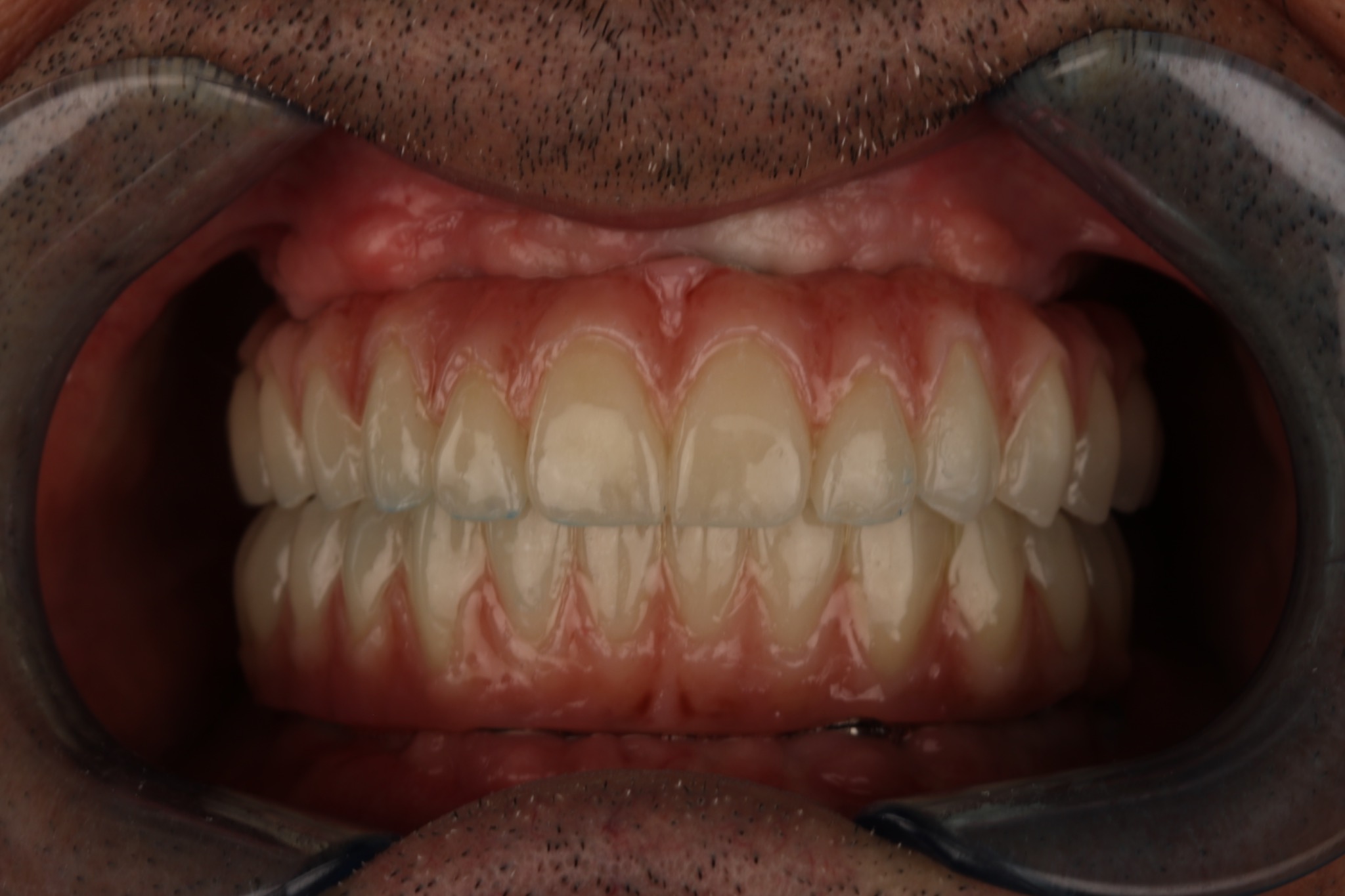 Carga inmediata: recupera tu sonrisa el mismo día