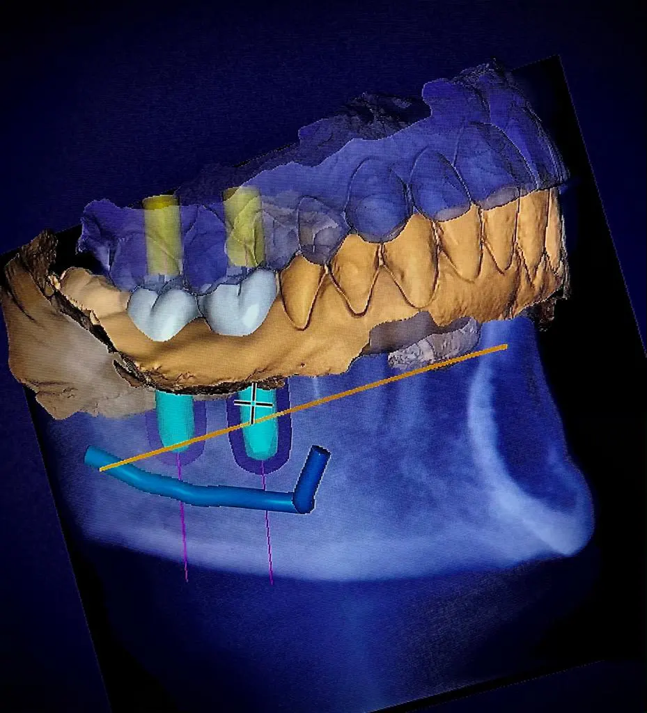 Cirugía guiada en implantes dentales