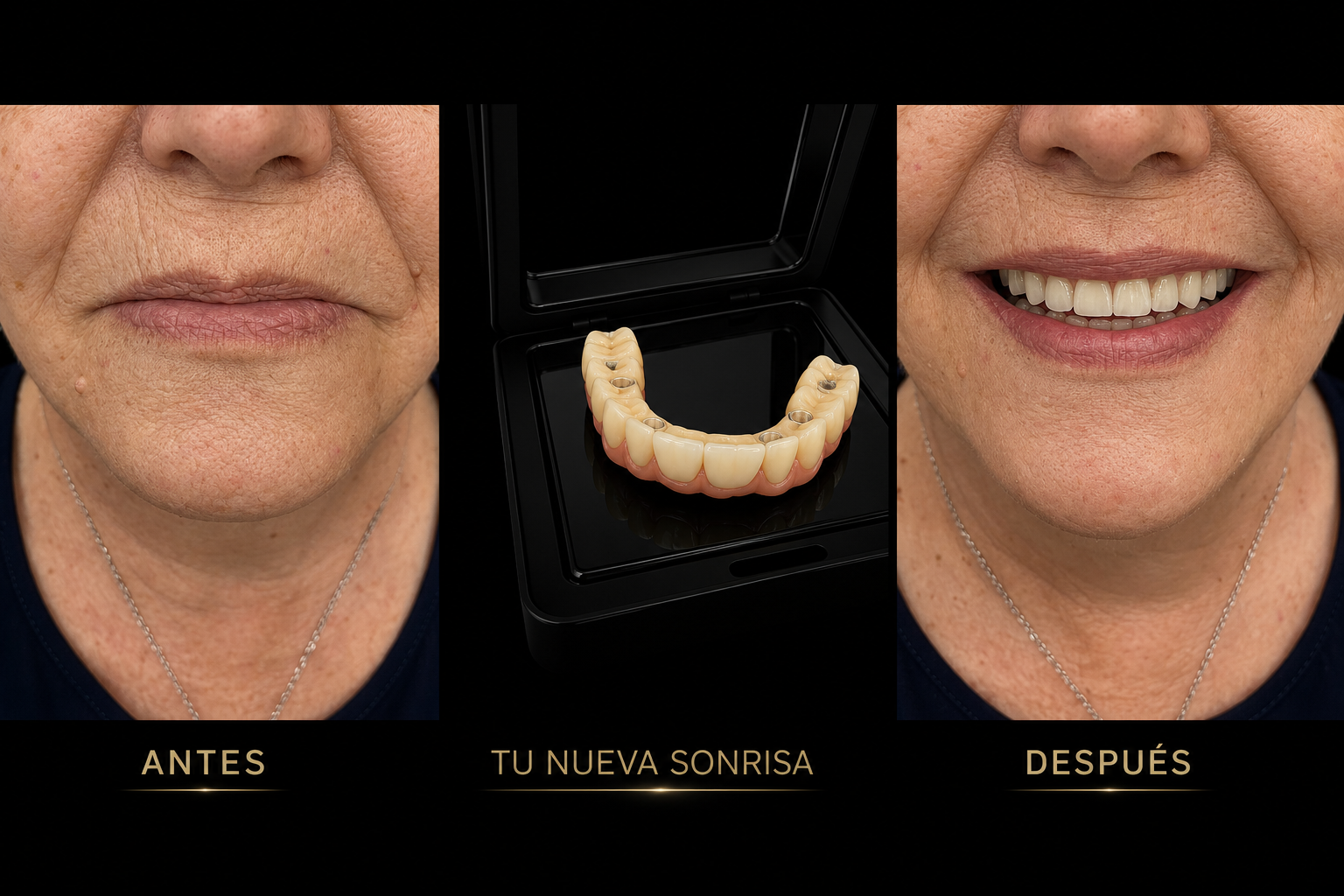 Prótesis híbrida sobre 4 implantes